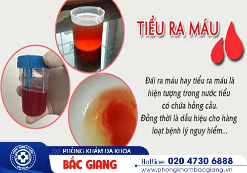 Tiểu ra máu báo hiệu điều gì?