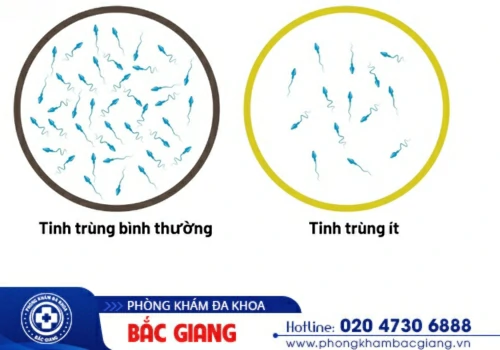 Tinh Trùng Ít Có Phải Là Vô Sinh?Dấu Hiệu Nhận Biết
