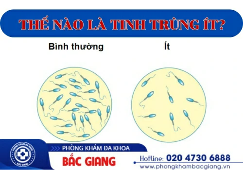 Tinh trùng ít: Cảnh báo nguy cơ vô sinh!