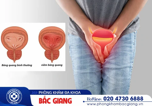 Điểm mặt những triệu chứng viêm bàng quang ở nam giới