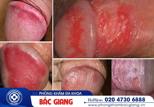 viêm bao quy đầu mãn tính 