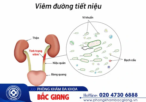 Triệu chứng viêm đường tiết niệu và cách chữa trị hiệu quả