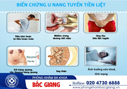 U nang tuyến tiền liệt - Căn bệnh bất kỳ nam giới nào cũng có nguy cơ mắc phải
