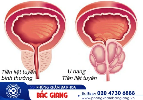 thuốc u nang tuyến tiền liệt