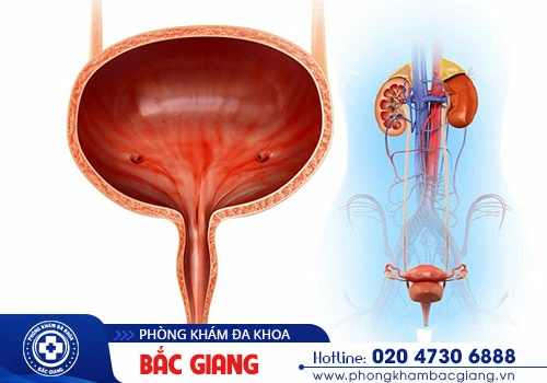 Viêm bàng quang kẽ là gì? Triệu chứng của bệnh như thế nào?