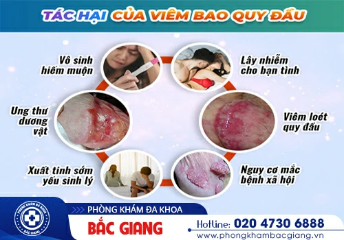 viêm bao quy đầu mãn tính 