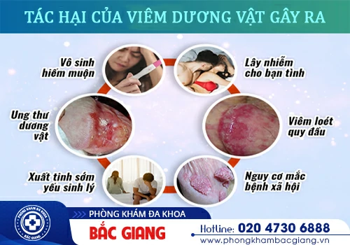 Viêm dương vật - Căn bệnh sinh dục nam không thể chủ quan