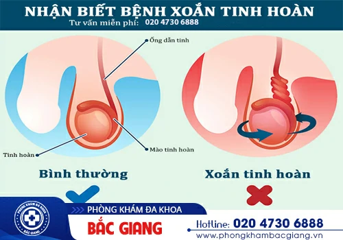 Xoắn tinh hoàn - Trường hợp cấp cứu ngoại khoa cần điều trị kịp thời