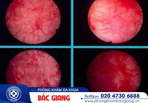 Xuất huyết bàng quang -  Triệu chứng nguy hiểm không thể xem thường